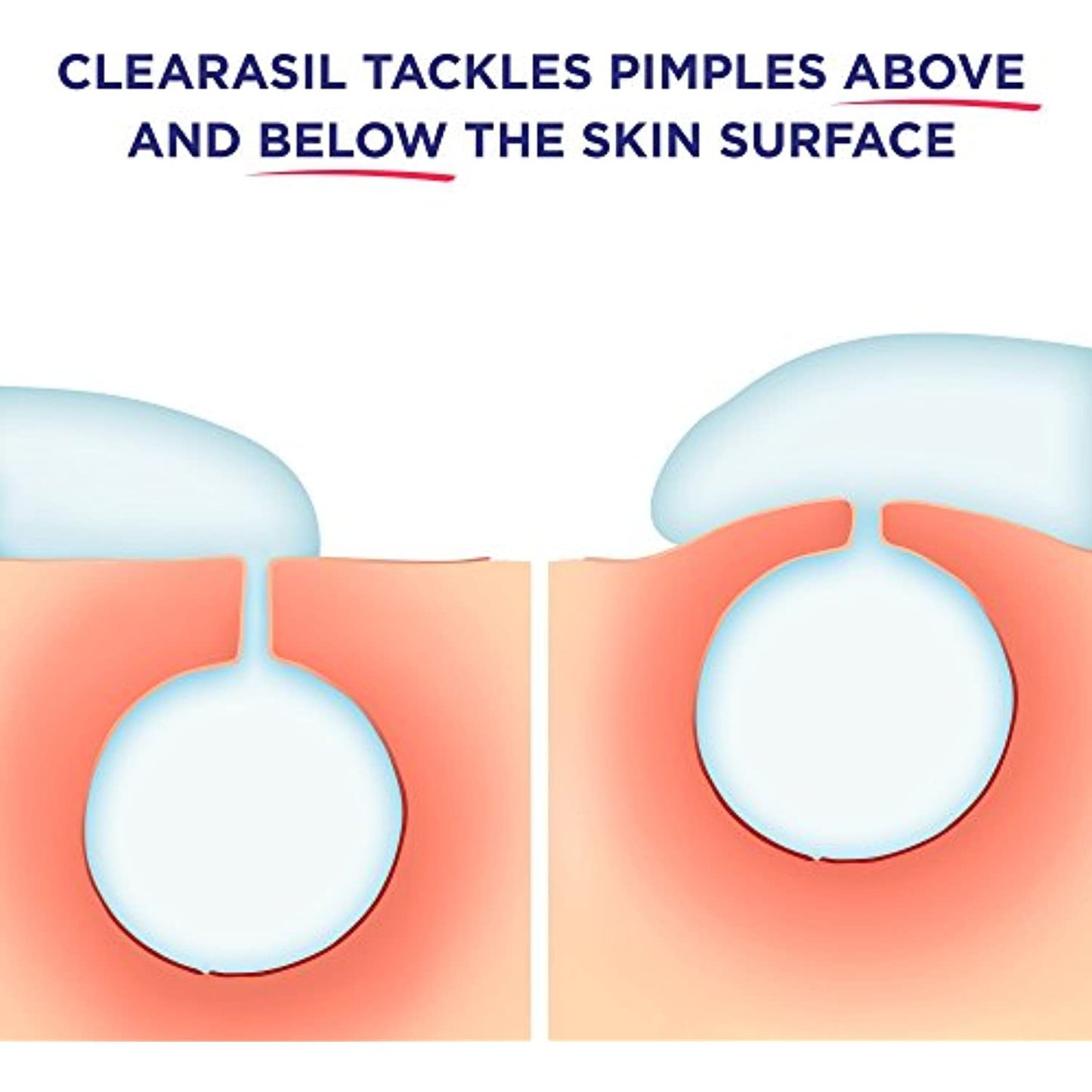 Clearasil Rapid Rescue, Deep Treatment Wash 6.78 oz (Pack of 3) EXP 7/22